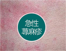 荨麻疹