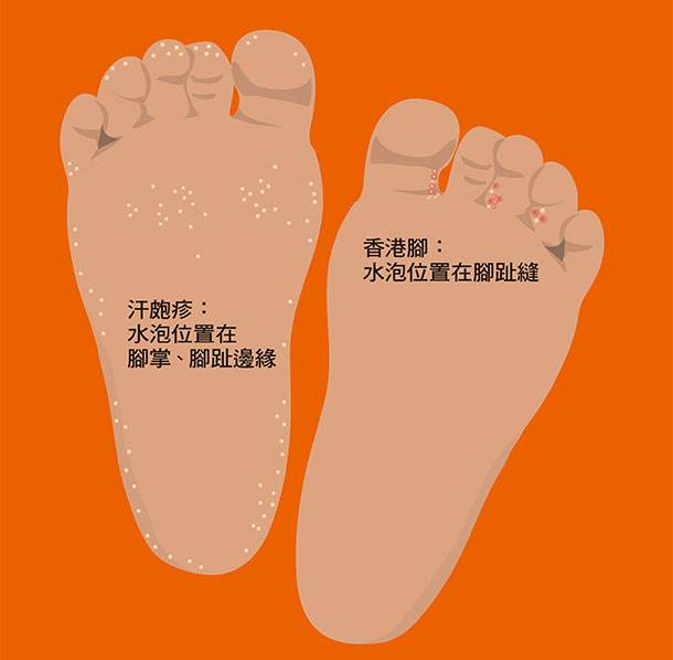 汗疱疹就是香港脚吗?